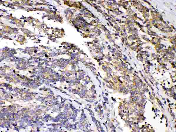 PRKAR1A Antibody - PRKAR1A was detected in paraffin-embedded sections of human lung cancer tissues using rabbit anti- PRKAR1A Antigen Affinity purified polyclonal antibody