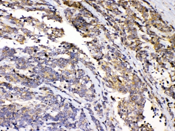 PRKAR1A Antibody - IHC testing of FFPE human lung cancer tissue with PRKAR1A antibody at 1ug/ml. Required HIER: steam section in pH6 citrate buffer for 20 min and allow to cool prior to testing.