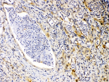 PRKAR1A Antibody - IHC testing of FFPE human intestinal cancer tissue with PRKAR1A antibody at 1ug/ml. Required HIER: steam section in pH6 citrate buffer for 20 min and allow to cool prior to testing.