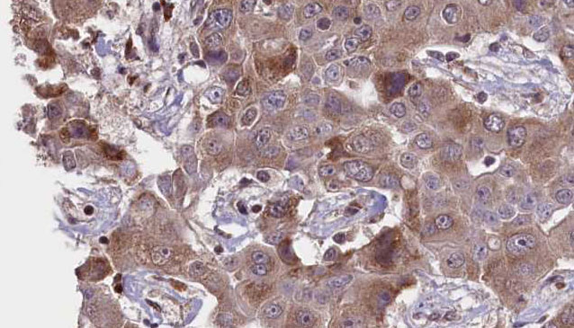 PRKAR1A Antibody - 1:100 staining human liver carcinoma tissues by IHC-P. The sample was formaldehyde fixed and a heat mediated antigen retrieval step in citrate buffer was performed. The sample was then blocked and incubated with the antibody for 1.5 hours at 22°C. An HRP conjugated goat anti-rabbit antibody was used as the secondary.