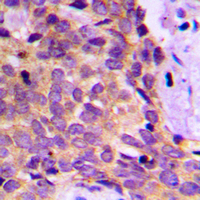 PRKAR1B Antibody - Immunohistochemical analysis of PRKAR1B staining in human breast cancer formalin fixed paraffin embedded tissue section. The section was pre-treated using heat mediated antigen retrieval with sodium citrate buffer (pH 6.0). The section was then incubated with the antibody at room temperature and detected using an HRP conjugated compact polymer system. DAB was used as the chromogen. The section was then counterstained with hematoxylin and mounted with DPX.