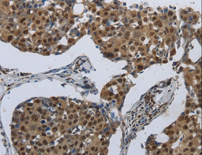 PRKAR1B Antibody - Immunohistochemistry of paraffin-embedded Human breast cancer using PRKAR1B Polyclonal Antibody at dilution of 1:70.