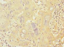 PRKAR1B Antibody - Immunohistochemistry of paraffin-embedded human liver cancer at dilution 1:100