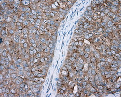 PRKAR2A Antibody - IHC of paraffin-embedded Adenocarcinoma of ovary tissue using anti-PRKAR2A mouse monoclonal antibody. (Dilution 1:50).