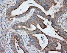 PRKAR2A Antibody - IHC of paraffin-embedded Adenocarcinoma of colon tissue using anti-PRKAR2A mouse monoclonal antibody. (Dilution 1:50).