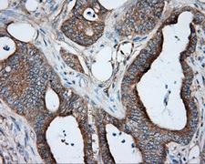 PRKAR2A Antibody - IHC of paraffin-embedded Adenocarcinoma of colon tissue using anti-PRKAR2A mouse monoclonal antibody. (Dilution 1:50).
