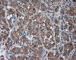 PRKAR2A Antibody - IHC of paraffin-embedded Carcinoma of liver tissue using anti-PRKAR2A mouse monoclonal antibody. (Dilution 1:50).