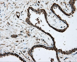 PRKAR2A Antibody - IHC of paraffin-embedded Carcinoma of prostate tissue using anti-PRKAR2A mouse monoclonal antibody. (Dilution 1:50).