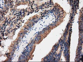 PRKAR2A Antibody - IHC of paraffin-embedded Carcinoma of Human prostate tissue using anti-PRKAR2A mouse monoclonal antibody.