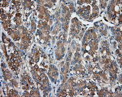 PRKAR2A Antibody - IHC of paraffin-embedded Carcinoma of liver tissue using anti-PRKAR2A mouse monoclonal antibody. (Dilution 1:50).