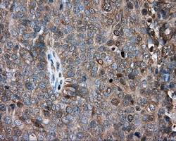 PRKAR2A Antibody - IHC of paraffin-embedded Adenocarcinoma of ovary tissue using anti-PRKAR2A mouse monoclonal antibody. (Dilution 1:50).