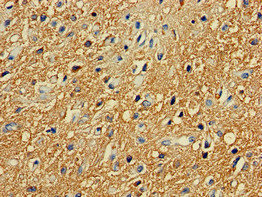 PRKAR2A Antibody - Immunohistochemistry of paraffin-embedded human glioma cancer at dilution of 1:100