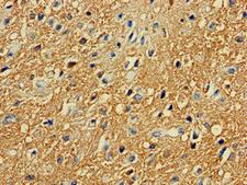 PRKAR2A Antibody - Immunohistochemistry of paraffin-embedded human glioma cancer at dilution of 1:100