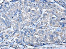 PRKAR2A Antibody - Immunohistochemistry of paraffin-embedded Human breast cancer tissue  using PRKAR2A Polyclonal Antibody at dilution of 1:50(×200)