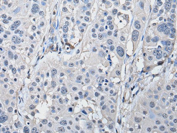 PRKAR2A Antibody - Immunohistochemistry of paraffin-embedded Human esophagus cancer tissue  using PRKAR2A Polyclonal Antibody at dilution of 1:50(×200)