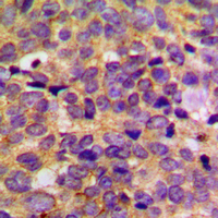 PRKAR2B Antibody - Immunohistochemical analysis of PRKAR2B staining in human breast cancer formalin fixed paraffin embedded tissue section. The section was pre-treated using heat mediated antigen retrieval with sodium citrate buffer (pH 6.0). The section was then incubated with the antibody at room temperature and detected using an HRP conjugated compact polymer system. DAB was used as the chromogen. The section was then counterstained with hematoxylin and mounted with DPX.