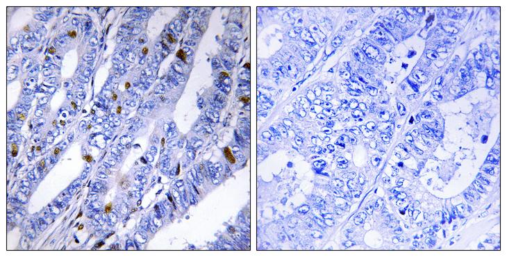 PRKAR2B Antibody - Peptide - + Immunohistochemistry analysis of paraffin-embedded human colon carcinoma tissue using PKA-R2ß (Ab-113) antibody.