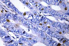 PRKAR2B Antibody - IHC of PKA II reg (T109) pAb in paraffin-embedded human cervix carcinoma tissue.