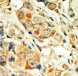 PRKCA / PKC-Alpha Antibody - Formalin-fixed and paraffin-embedded human cancer tissue reacted with the primary antibody, which was peroxidase-conjugated to the secondary antibody, followed by DAB staining. This data demonstrates the use of this antibody for immunohistochemistry; clinical relevance has not been evaluated. BC = breast carcinoma; HC = hepatocarcinoma.