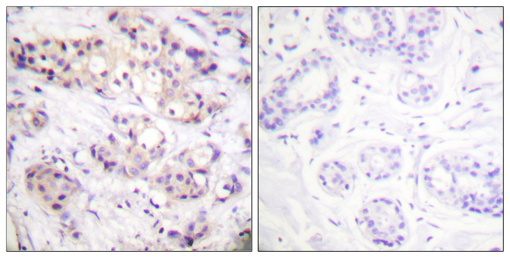 PRKCA / PKC-Alpha Antibody - Immunohistochemistry analysis of paraffin-embedded human breast carcinoma tissue, using PKC alpha Antibody. The picture on the right is blocked with the synthesized peptide.