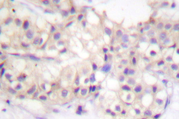 PRKCA / PKC-Alpha Antibody - IHC of PKC (G633) pAb in paraffin-embedded human breast.