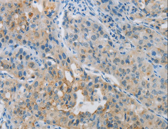 PRKCA / PKC-Alpha Antibody - Immunohistochemistry of paraffin-embedded Human lung cancer using PRKCA Polyclonal Antibody at dilution of 1:30.