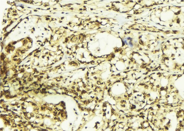 PRKCA / PKC-Alpha Antibody - 1:100 staining human breast carcinoma tissue by IHC-P. The sample was formaldehyde fixed and a heat mediated antigen retrieval step in citrate buffer was performed. The sample was then blocked and incubated with the antibody for 1.5 hours at 22°C. An HRP conjugated goat anti-rabbit antibody was used as the secondary.