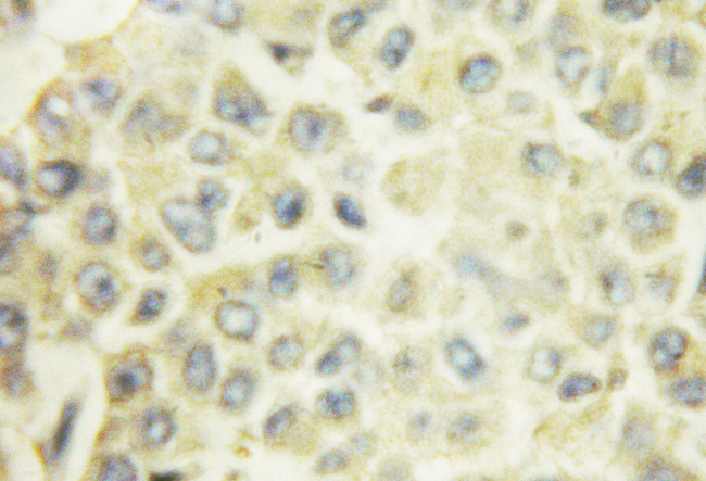 PRKCA / PKC-Alpha Antibody - 1/100 staining human liver cancer tissue by IHC-P. The sample was formaldehyde fixed and a heat mediated antigen retrieval step in citrate buffer was performed. The sample was then blocked and incubated with the antibody for 1.5 hours at 22°C. An HRP conjugated goat anti-rabbit antibody was used as the secondary antibody.