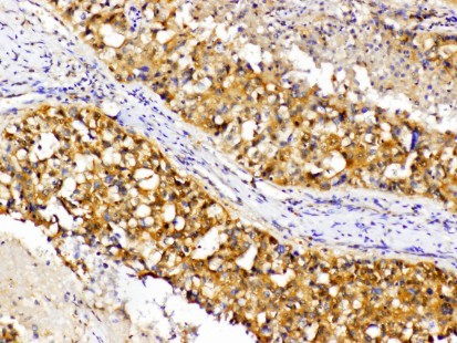 PRKCA / PKC-Alpha Antibody - IHC of p-PKC (T638) pAb in paraffin-embedded human hepatic carcinoma tissue.