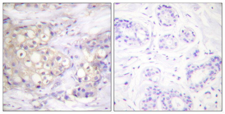 PRKCA / PKC-Alpha Antibody - Immunohistochemistry analysis of paraffin-embedded human breast carcinoma, using PKC alpha (Phospho-Thr638) Antibody. The picture on the right is blocked with the phospho peptide.