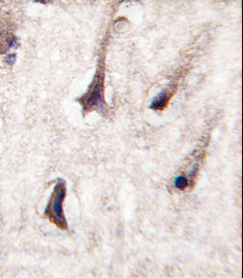 PRKCB / PKC-Beta Antibody - Formalin-fixed and paraffin-embedded human brain tissue reacted with PKC beta2 antibody , which was peroxidase-conjugated to the secondary antibody, followed by DAB staining. This data demonstrates the use of this antibody for immunohistochemistry; clinical relevance has not been evaluated.