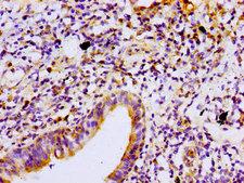 PRKCB / PKC-Beta Antibody - Immunohistochemistry image of paraffin-embedded human lung cancer at a dilution of 1:100