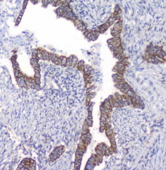 PRKCB / PKC-Beta Antibody - IHC staining of FFPE human intestinal cancer with PKC beta antibody at 1ug/ml. HIER: boil tissue sections in pH6, 10mM citrate buffer, for 10-20 min followed by cooling at RT for 20 min.
