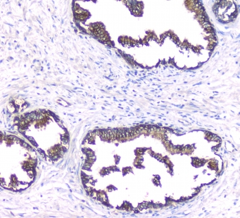 PRKCB / PKC-Beta Antibody - IHC staining of FFPE human prostate cancer with PKC beta antibody at 1ug/ml. HIER: boil tissue sections in pH6, 10mM citrate buffer, for 10-20 min followed by cooling at RT for 20 min.