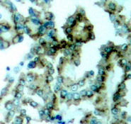 PRKCB / PKC-Beta Antibody - Immunohistochemical analysis of paraffin-embedded human lung carcinoma tissue.