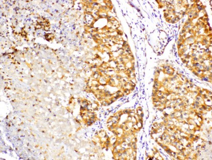 PRKCD / PKC-Delta Antibody - IHC of PKC (G499)pAb in paraffin-embedded human hepatic carcinoma tissue.