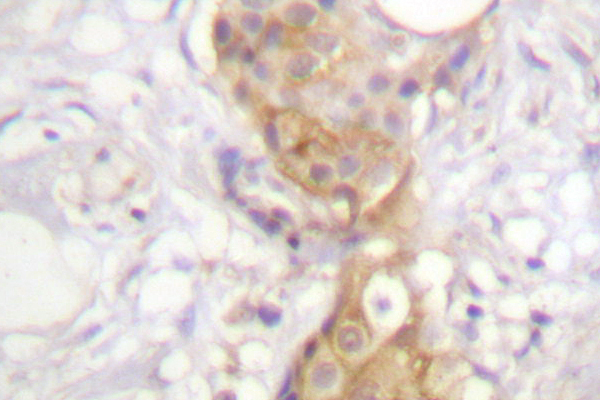 PRKCD / PKC-Delta Antibody - IHC of PKC (G499) pAb in paraffin-embedded human breast carcinoma tissue.