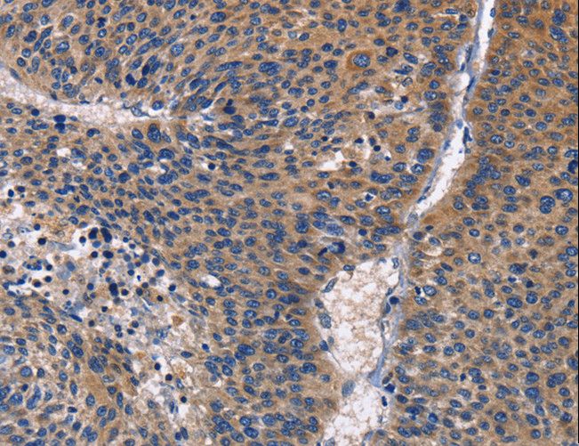 PRKCD / PKC-Delta Antibody - Immunohistochemistry of paraffin-embedded Human liver cancer using PRKCD Polyclonal Antibody at dilution of 1:30.