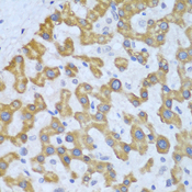 PRKCD / PKC-Delta Antibody - Immunohistochemistry of paraffin-embedded human liver cancer using PRKCD antibodyat dilution of 1:100 (40x lens).