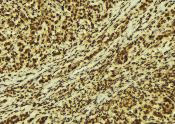 PRKCD / PKC-Delta Antibody - 1:100 staining human breast carcinoma tissue by IHC-P. The sample was formaldehyde fixed and a heat mediated antigen retrieval step in citrate buffer was performed. The sample was then blocked and incubated with the antibody for 1.5 hours at 22°C. An HRP conjugated goat anti-rabbit antibody was used as the secondary.