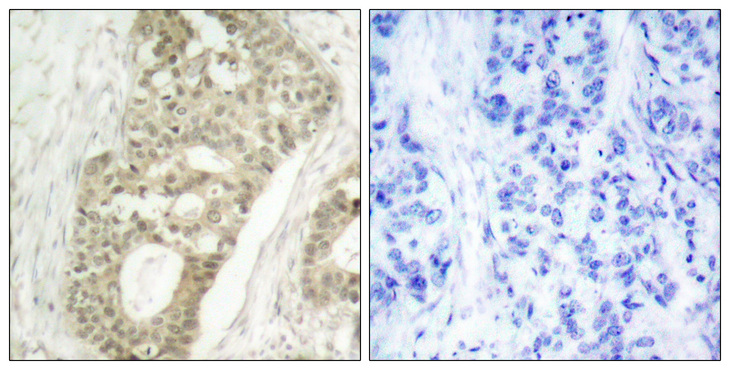 PRKCD / PKC-Delta Antibody - Immunohistochemistry analysis of paraffin-embedded human breast carcinoma, using PKC delta (Phospho-Ser645) Antibody. The picture on the right is blocked with the phospho peptide.