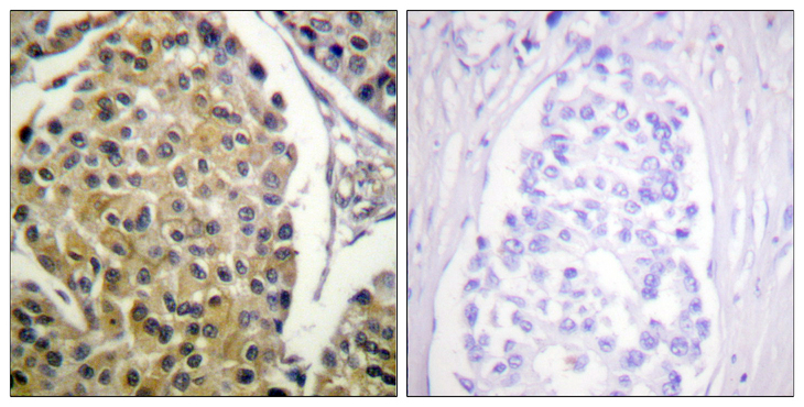 PRKCD / PKC-Delta Antibody - Immunohistochemistry analysis of paraffin-embedded human breast carcinoma, using PKC delta (Phospho-Tyr313) Antibody. The picture on the right is blocked with the phospho peptide.