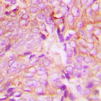 PRKCD / PKC-Delta Antibody - Immunohistochemical analysis of PKC delta (pY313) staining in human breast cancer formalin fixed paraffin embedded tissue section. The section was pre-treated using heat mediated antigen retrieval with sodium citrate buffer (pH 6.0). The section was then incubated with the antibody at room temperature and detected using an HRP conjugated compact polymer system. DAB was used as the chromogen. The section was then counterstained with hematoxylin and mounted with DPX.