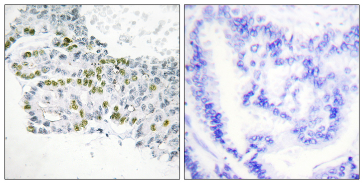 PRKCD / PKC-Delta Antibody - Immunohistochemistry analysis of paraffin-embedded human lung carcinoma, using PKC delta (Phospho-Tyr52) Antibody. The picture on the right is blocked with the phospho peptide.