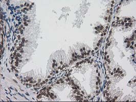 PRKCE / PKC-Epsilon Antibody - IHC of paraffin-embedded Human prostate tissue using anti-PRKCE mouse monoclonal antibody.