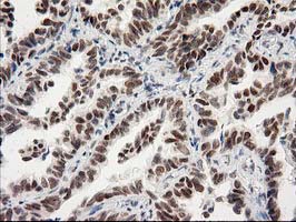 PRKCE / PKC-Epsilon Antibody - IHC of paraffin-embedded Carcinoma of Human lung tissue using anti-PRKCE mouse monoclonal antibody.