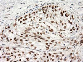 PRKCE / PKC-Epsilon Antibody - IHC of paraffin-embedded Carcinoma of Human pancreas tissue using anti-PRKCE mouse monoclonal antibody.
