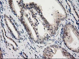 PRKCE / PKC-Epsilon Antibody - IHC of paraffin-embedded Carcinoma of Human prostate tissue using anti-PRKCE mouse monoclonal antibody.
