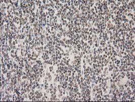 PRKCE / PKC-Epsilon Antibody - IHC of paraffin-embedded Human lymphoma tissue using anti-PRKCE mouse monoclonal antibody.