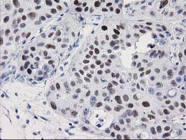 PRKCE / PKC-Epsilon Antibody - IHC of paraffin-embedded Carcinoma of Human bladder tissue using anti-PRKCE mouse monoclonal antibody.